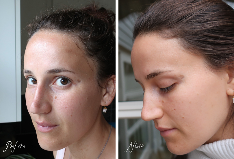 How I Got Rid Of My Hyperpigmentation In One Month Exact Skincare 