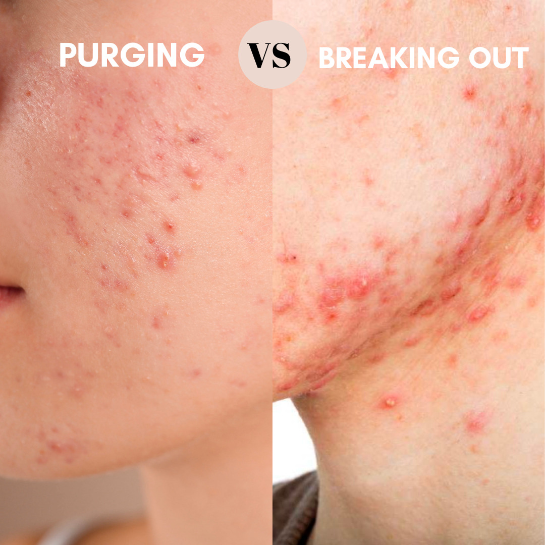 Purging Vs Breaking Out Are You Just Breaking Out Healthy Skin Glows